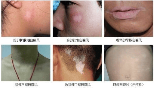 [名單即時公開]泉州治白斑去哪個醫院最好？小童臉上有一塊白點怎么去掉？